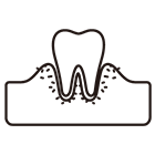 歯肉炎、歯槽膿漏のイラスト